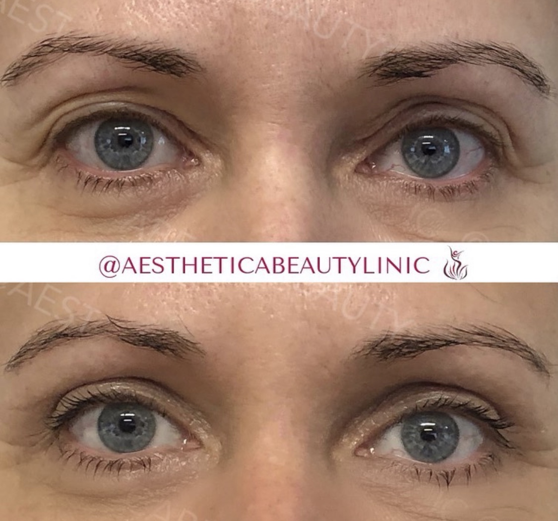 Blepharoplasty