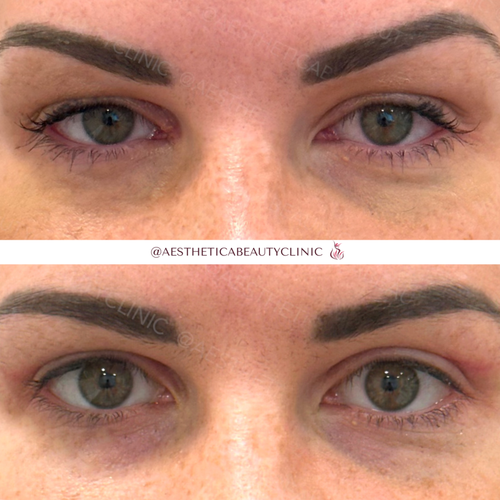 Blefaroplasty