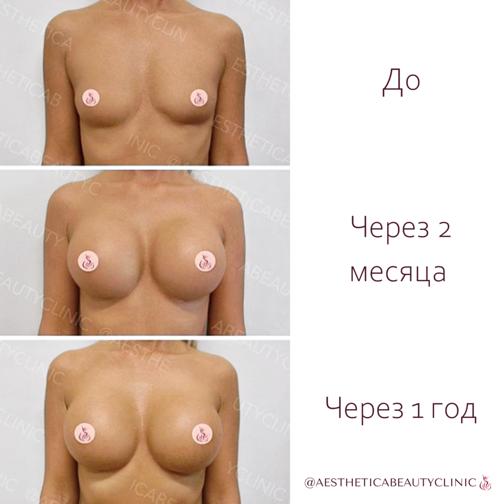Er (3)