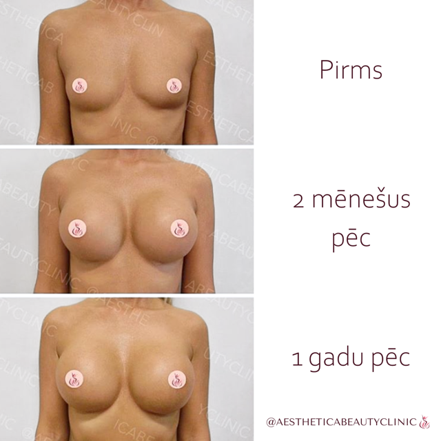 Er (5) Medium