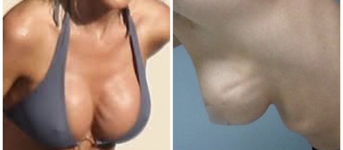 Krūšu implantu “RIPLINGS”