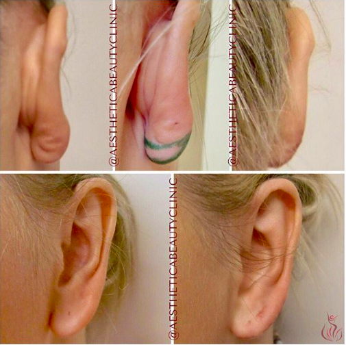 Ear corrections