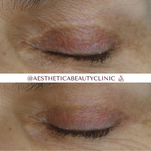 Blefaroplastika Mikropigmentacija
