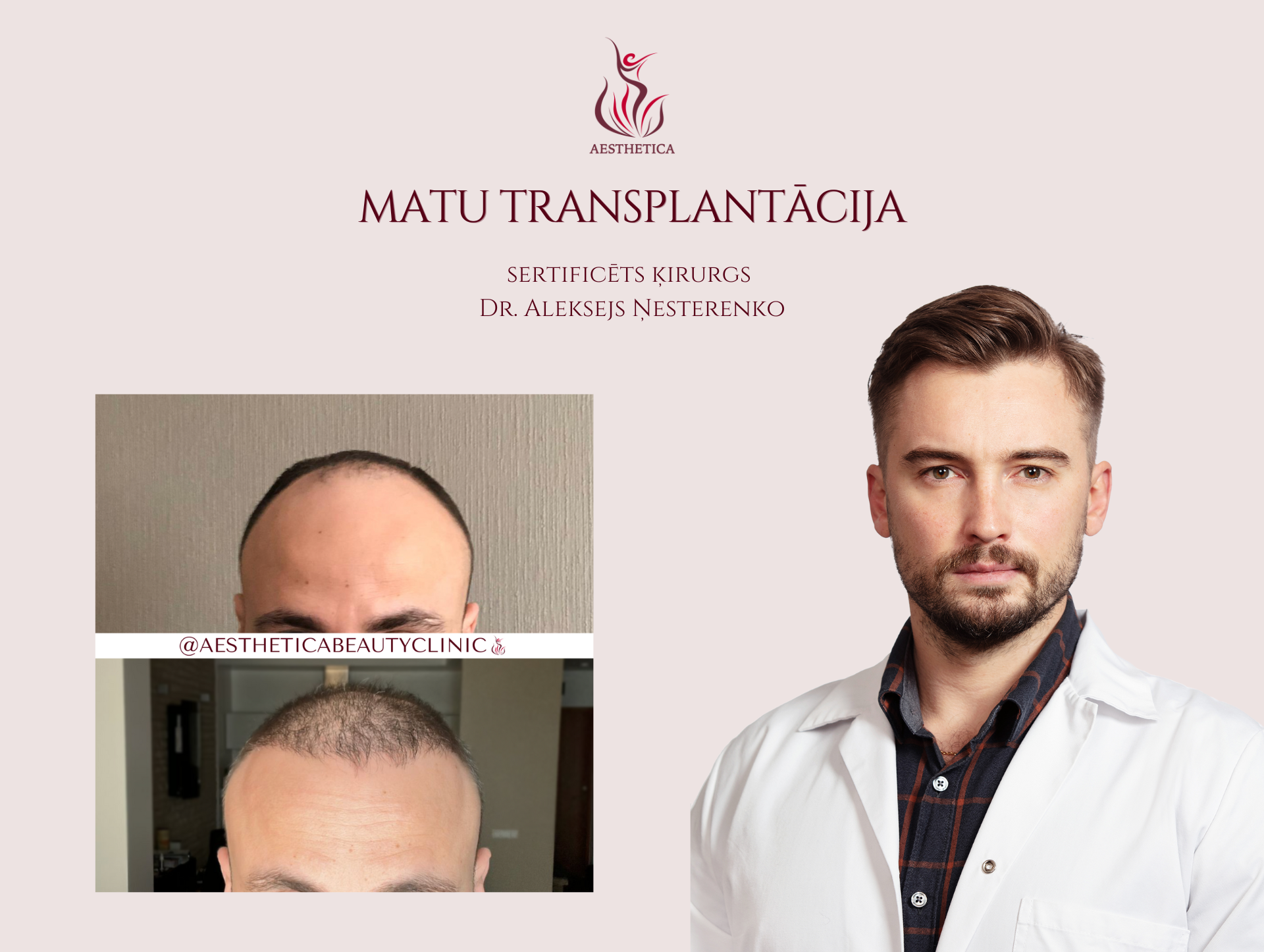 Matu Transplantacija Aleksejs Nesterenko