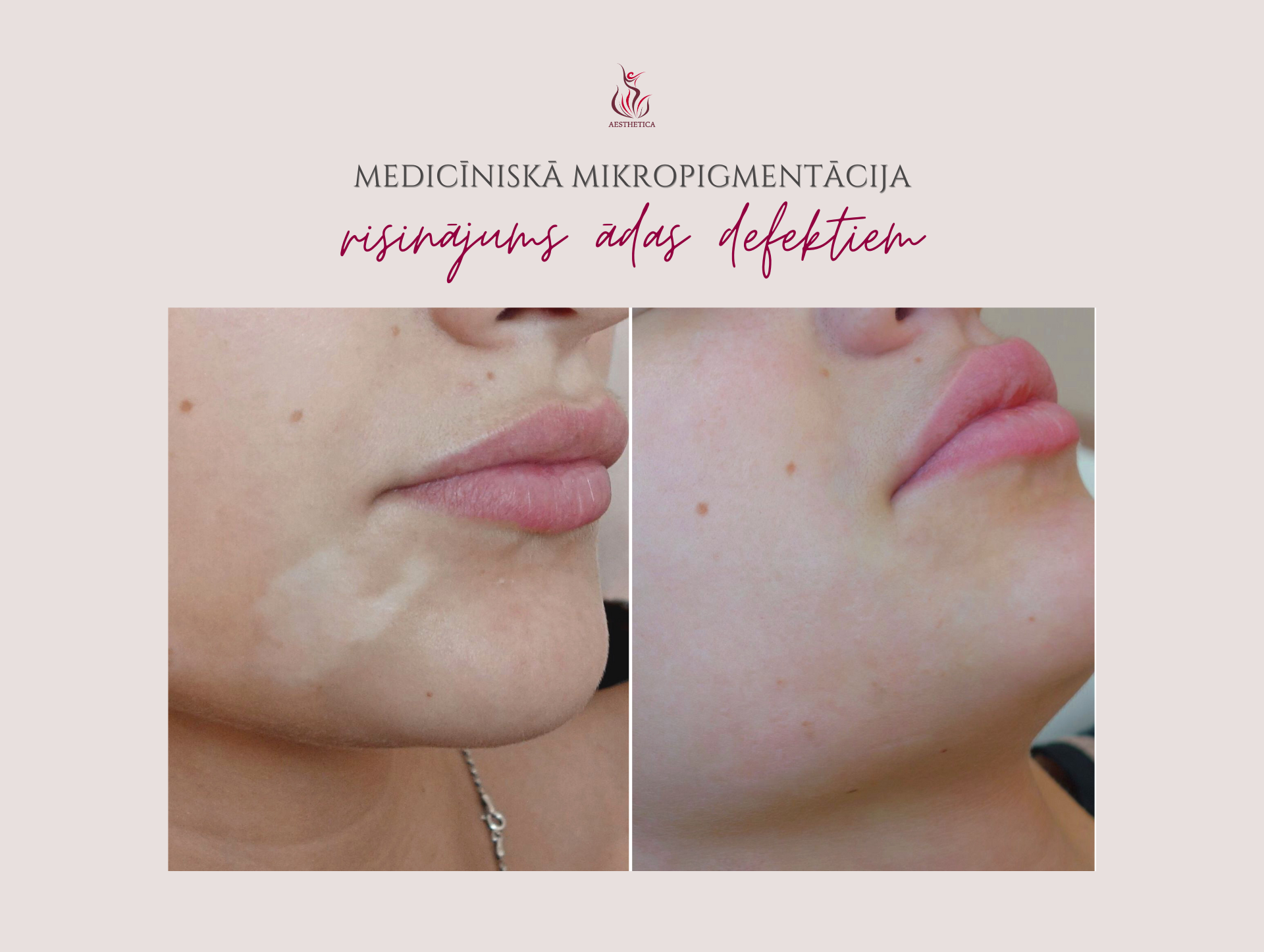 Mediciniska Mikropigmentacija