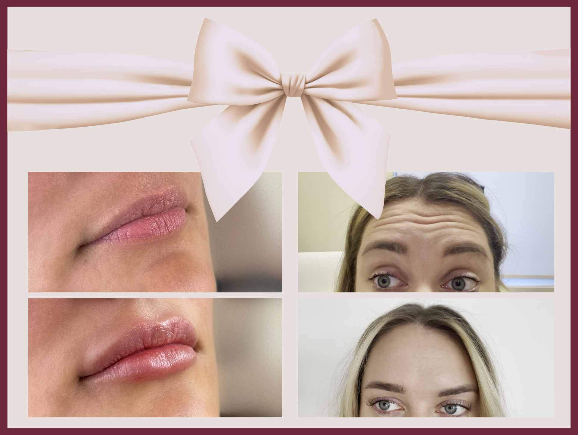 Botox